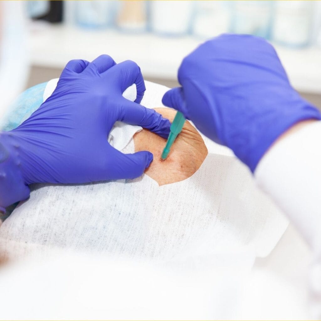 Zdjęcie przedstawia dermatologa usuwającego chirurgicznie zmianę skórną z ramienia pacjenta.