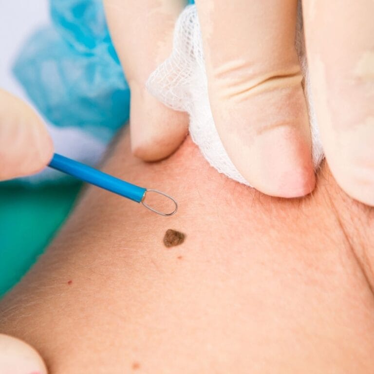 Zdjęcie przedstawia przebieg zabiegu elektrokoagulacji zmiany skórnej.