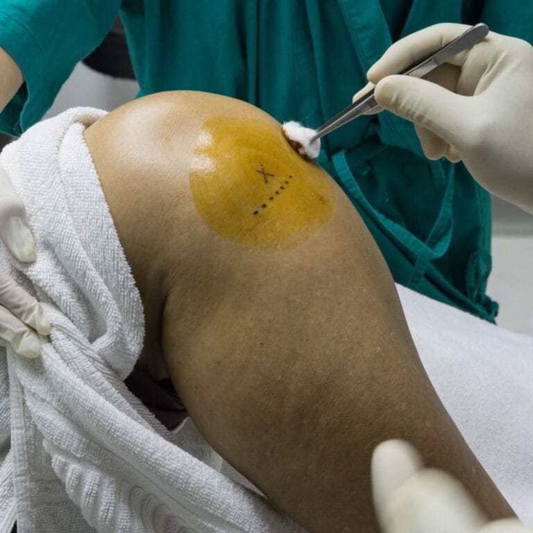 Zdjęcie przedstawia zabieg iniekcji dostawowej kwasu hialuronowego.