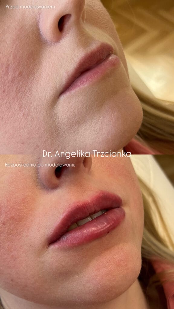 Zdjęcia przedstawiają usta pacjentki przed oraz po modelowaniu ust przez lekarkę medycyny estetycznej w Zabrzu.