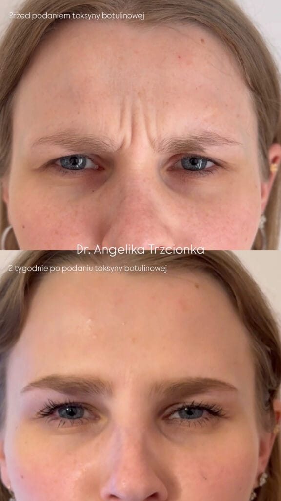 Zdjęcie przedstawia efekty terapii toksyną botulinową zmarszczek czoła. Zdjęcie przed i po skutecznej terapii botuliną uzyskując naturalny efekt.