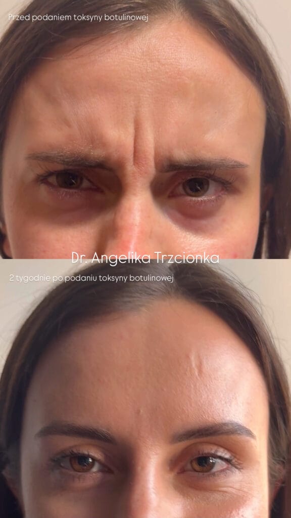 Zdjęcie przedstawia efekty terapii toksyną botulinową zmarszczek czoła. Zdjęcie przed i po skutecznej terapii botuliną uzyskując naturalny efekt.