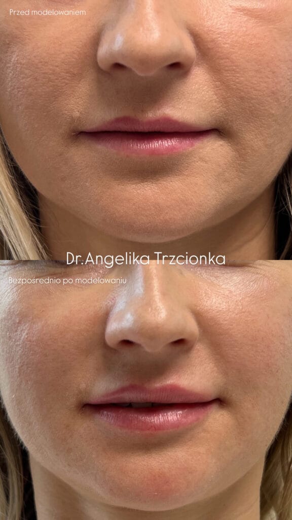 Zdjęcia przedstawiają usta pacjentki przed oraz po modelowaniu ust przez lekarkę medycyny estetycznej w Zabrzu.