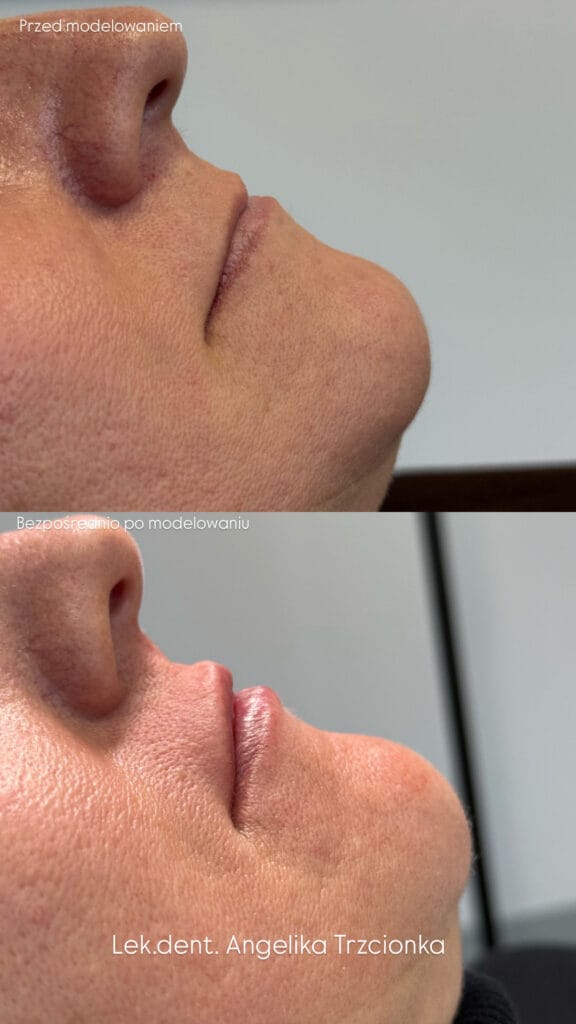 Zdjęcia przedstawiają usta pacjentki przed oraz po modelowaniu ust kwasem hialuronowym przez lekarkę medycyny estetycznej Angelikę Trzcionkę w Zabrzu.