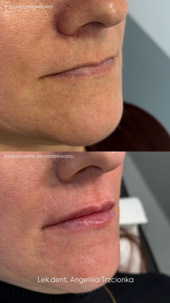 Zdjęcia przedstawiają usta pacjentki przed oraz po modelowaniu ust kwasem hialuronowym przez lekarkę medycyny estetycznej Angelikę Trzcionkę w Zabrzu.